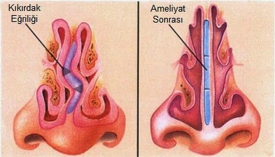 Septoplasti-SMR-Ameliyati